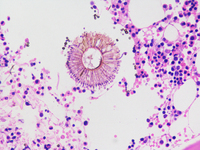 Invasive Aspergillosis in bone marrow 1