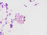 Fruiting Bodies of Aspergillus in bone marrow