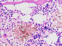 Invasive Aspergillosis in bone marrow 2