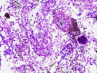 Invasive Aspergillosis in bone marrow - PAS stain 1