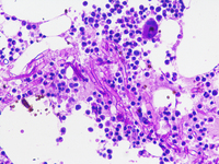 Invasive Aspergillosis in bone marrow - PAS stain 2