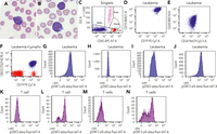 Constitutive STAT5 activation in precursor B-cell acute lymphoblastic leukemia with P2RY8::CRLF2 fusion