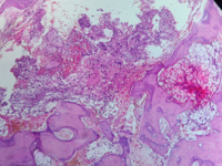 Bone marrow metastasis in prostate carcinoma 1