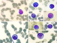 Plasma cell leukemia