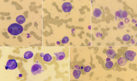 Plasma cell myeloma 1