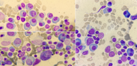 Plasma cell myeloma 1