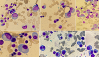 Plasma cell myeloma 3