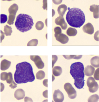 APML with Auer Rods; Flow cytometry 2