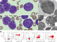 Near early T-precursor lymphoblastic leukemia with marked flower petal nuclei: blast with unique cyanthiform nucleus