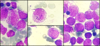 Faggot cells in acute promyelocytic leukemia