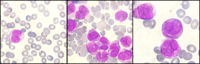 Atypical promyelocytes in AML M3 variant