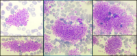 EDTA-Dependent severe pseudothrombocytopenia