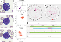 B-cell acute lymphoblastic leukemia with MEF2D::BCL9 rearrangement mimicking a Burkitt lymphoma