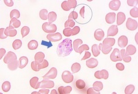 A Hyena cannot spare the feeble: Plasmodium Vivax in a follow up case of Sickle cell Anaemia
