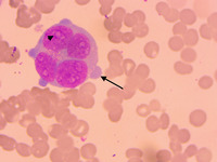 Quadri-nucleated giant proeythroblast in a case of Parvovirus B-19 infection