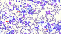 CMML associated secondary HLH