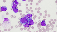 AML with NUP98::HOXA13 fusion and FLT3-ITD