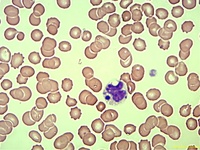 Howel-jolly like bodies in Neutrophils. 2