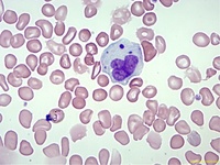 Pseudo-chediak higashi granules in monocyte