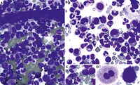 Atypical chronic myeloid leukemia: from cytology to molecular characterization