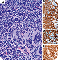 Warthin-Finkeldey cells seen in a setting other than measles: chronic lymphocytic leukemia/small lymphocytic lymphoma