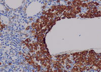 Bone marrow trephine myeloperoxidase stain    (20 x hpf)