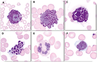 Giant cytoplasmic inclusions (Alder-Reilly bodies) in Hurler syndrome (mucopolysaccharidosis type 1H)