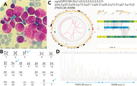 Chromoplexy and FNDC3B::RARB fusion: deciphering a rare case of PML::RARA-negative APL