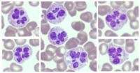 Botryoid neutrophils - cocaine abuse