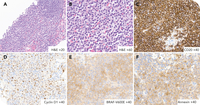 A rare case of nodal hairy cell leukemia exhibiting characteristic morphological and immunohistochemical features