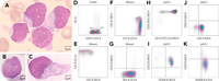 Early T-precursor acute lymphoblastic leukemia with mature plasmacytoid dendritic cell proliferation