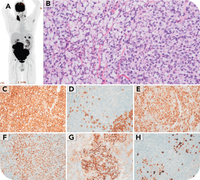 When lymphoma mimics adenocarcinoma: signet ring morphology in follicular lymphoma