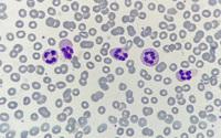 Neutrophil hyper-segmentation 1