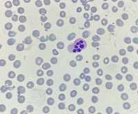 Neutrophil hyper-segmentation 2