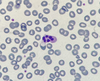Neutrophil hyper-segmentation 3
