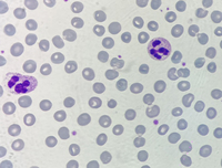 Neutrophil hyper-segmentation 4