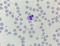 Neutrophil hyper-segmentation 5