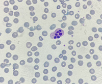 Neutrophil hyper-segmentation 7