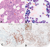Myelodysplastic neoplasm with biallelic TP53 inactivation in a patient with plasma cell myeloma after cytotoxic therapy