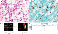 Clonal γδ T-cell proliferation associated with Babesia infection: a rare and challenging diagnostic pitfall