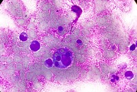Hemophagocytosis (Bone marrow aspirate)