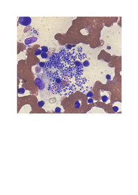 Histoplasmosis in Bone Marrow aspirate