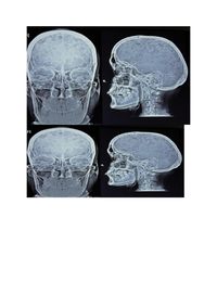 Extensive lytic lesions in A Case of  MM