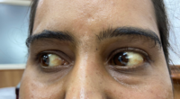 Eltrombopag induced yellowish of Sclera in Severe Aplastic Anemia patient