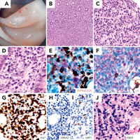 Adult T-cell leukemia/lymphoma coexistent with immune dysregulation–associated EBV lymphoproliferative disorder