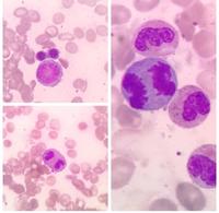 Abnormal Mitosis in Myelodysplastic Syndrome (MDS)