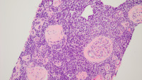 Kidney, H&E stain showing interstitial lymphocytes