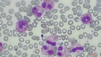 Eosinophilia in Chronic Eosinophilic Leukemia