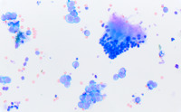 Vitreous Fluid with Detached Retinal Cells and Large B-cell Lymphoma