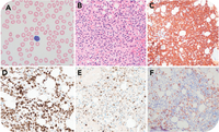Classic hairy cell leukemia and concomitant smoldering myeloma